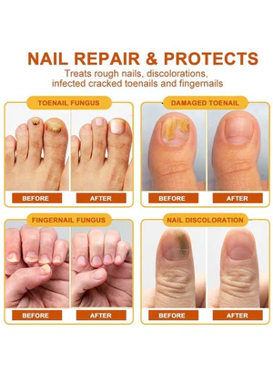 Sumifun - Bee Venom Fungal Nail Treatment Cream